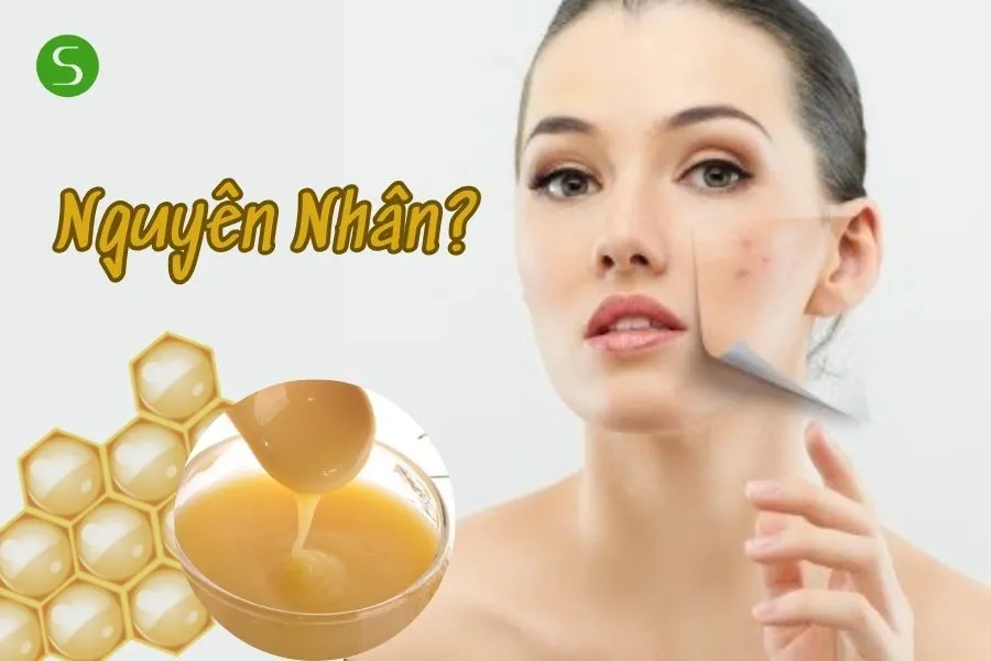 Nguyên nhân dẫn đến dị ứng sữa ong chúa là gì? 