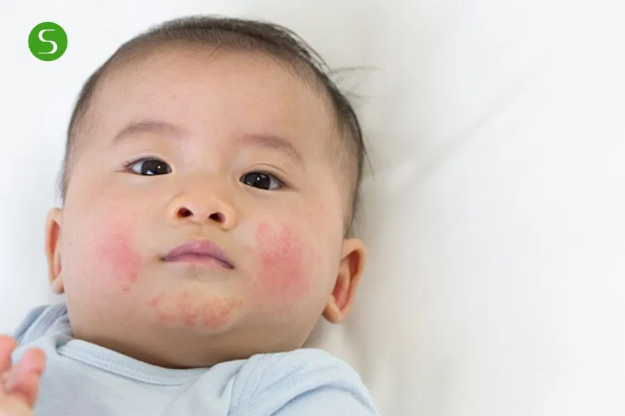 Dị ứng sữa là gì? Đối tượng có nguy có bệnh dị ứng sữa