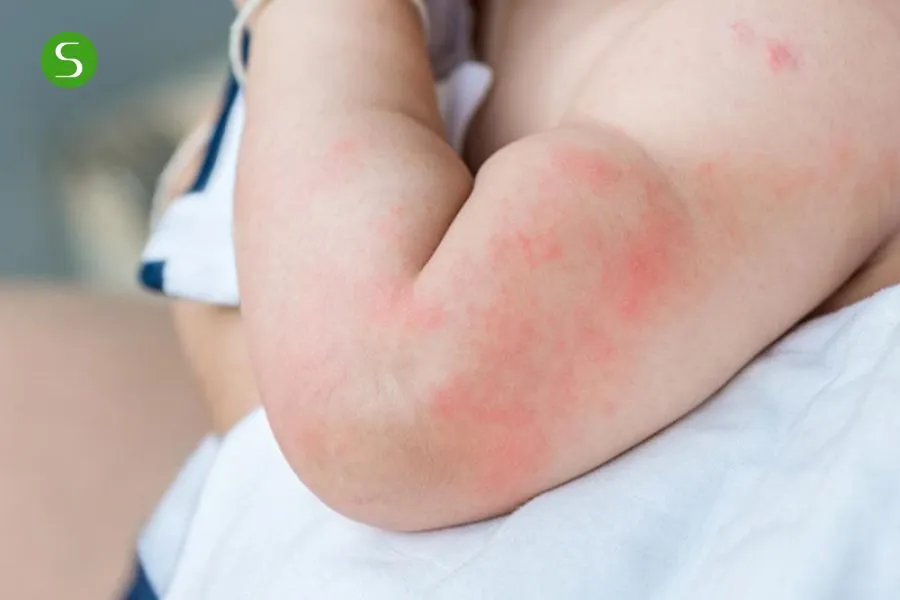 nguyên nhân phổ biến ở trẻ khi dị ứng sữa 