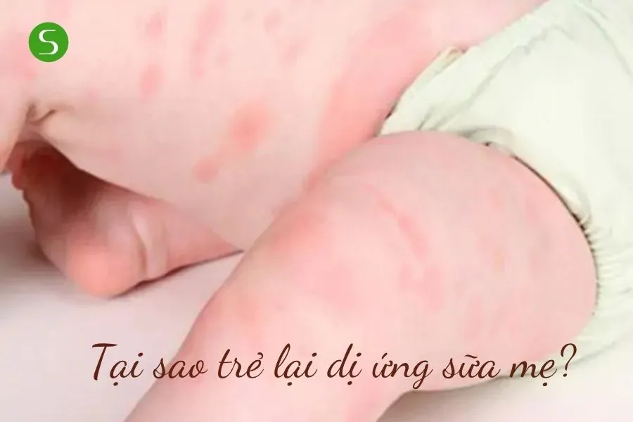 Tại sao trẻ lại dị ứng sữa mẹ?