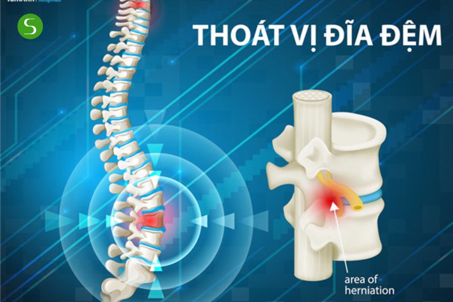 Cải thiện tuần hoàn máu và trao đổi chất quanh đĩa đệm